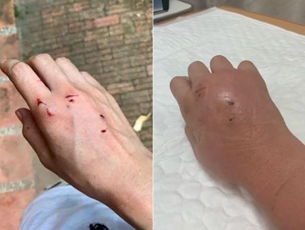 ฝันว่าแมวกัดมือ