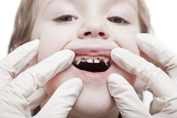 ฝันว่าฟันผุเป็นรู -"Dreaming about a tooth decaying.1"